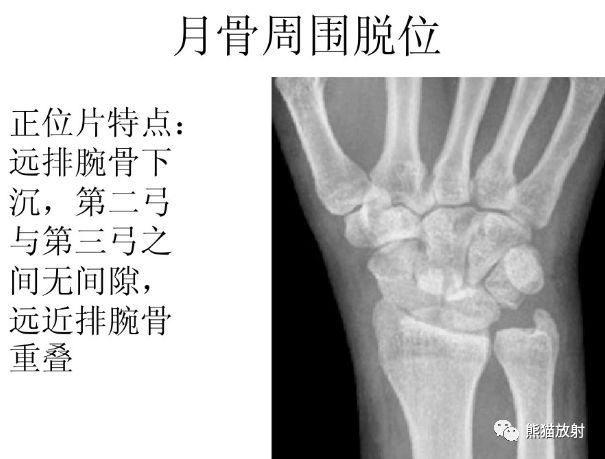 腕骨脱位的分类及X线表现
