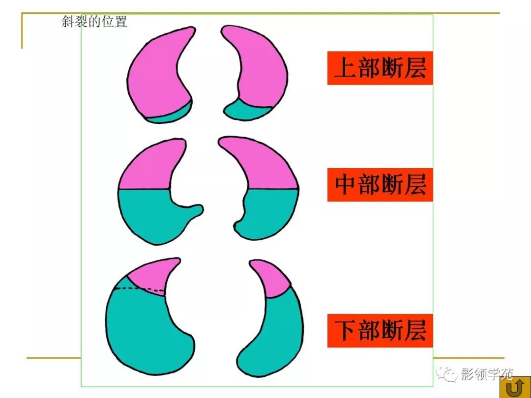 肺段与肺内管道应用解剖