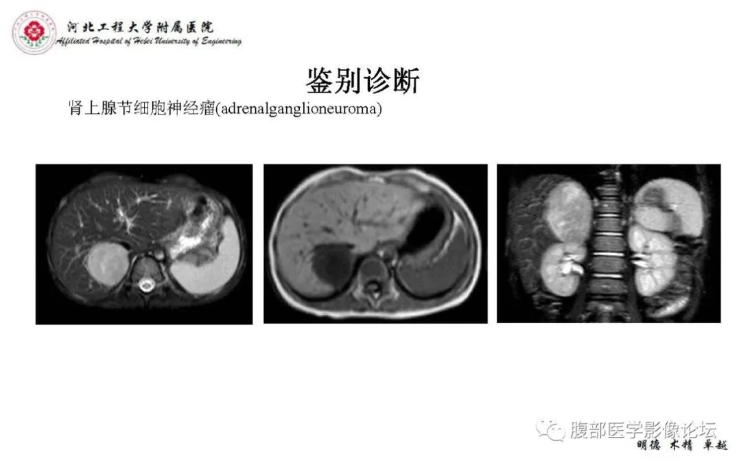 【PPT】肾上腺神经鞘瘤