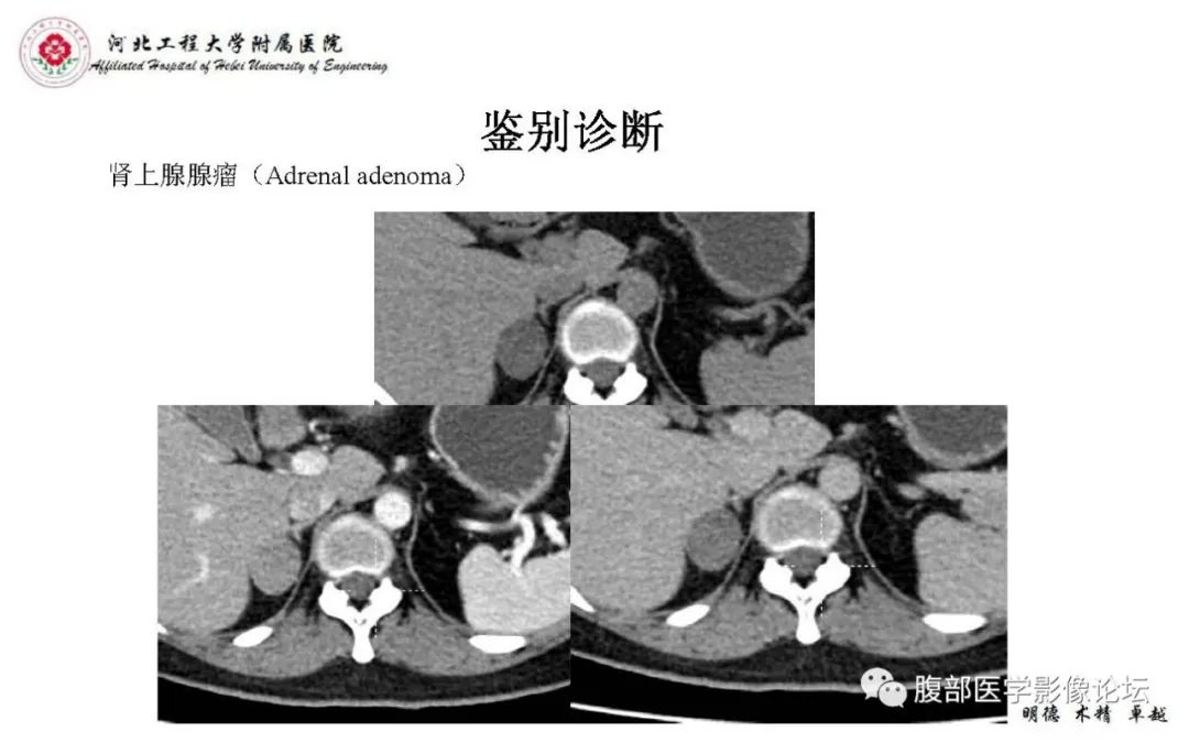 【PPT】肾上腺神经鞘瘤