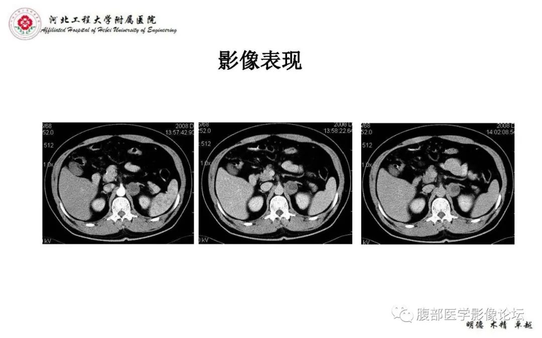 【PPT】肾上腺神经鞘瘤