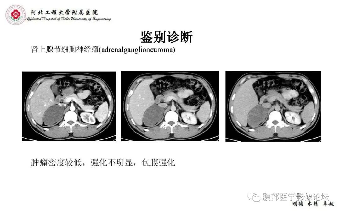 【PPT】肾上腺神经鞘瘤