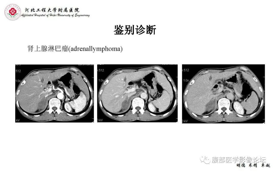 【PPT】肾上腺神经鞘瘤