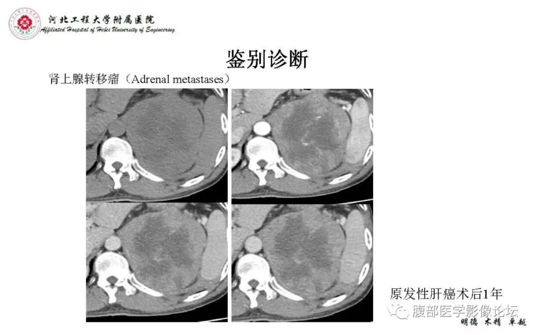 【PPT】肾上腺神经鞘瘤