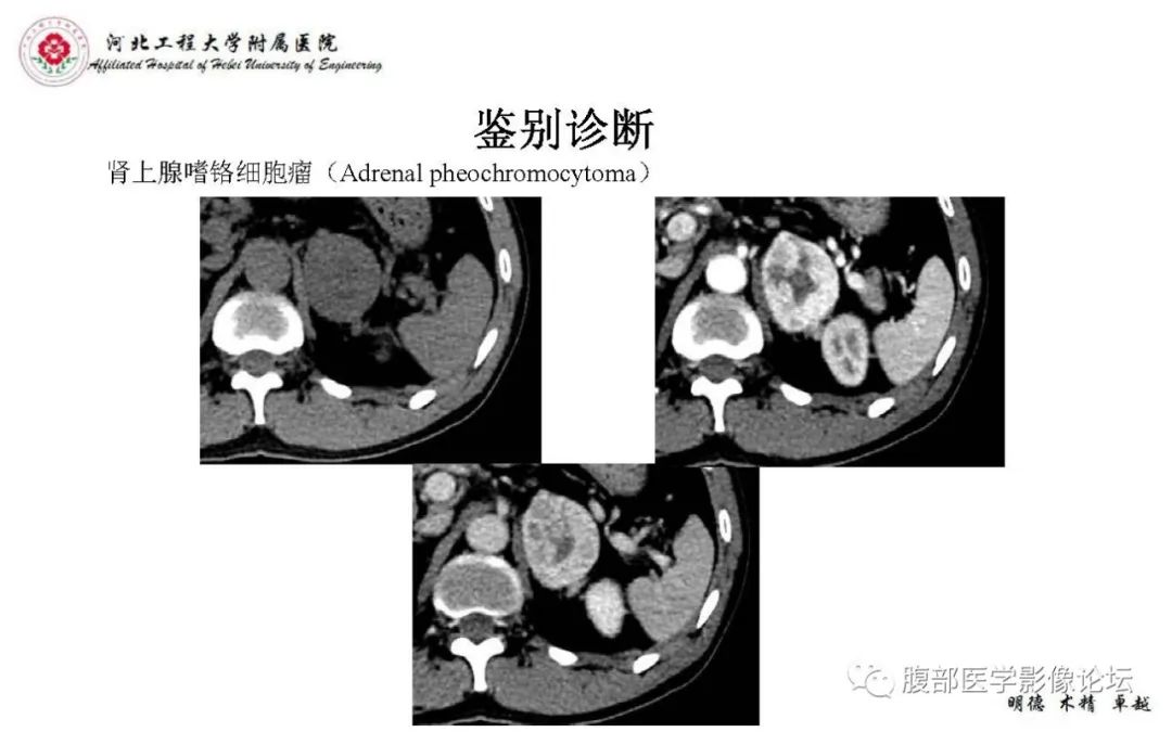 【PPT】肾上腺神经鞘瘤