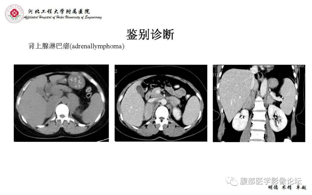【PPT】肾上腺神经鞘瘤