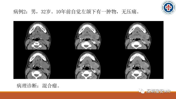【病例】颌下腺腺样囊腺癌1例CT影像