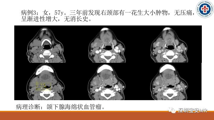 【病例】颌下腺腺样囊腺癌1例CT影像