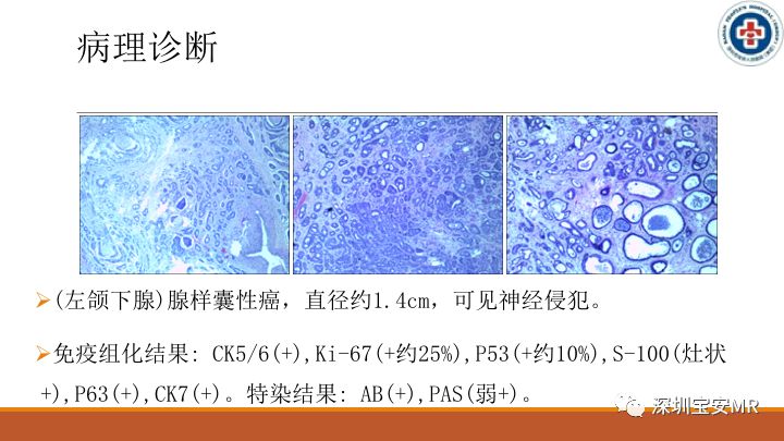 【病例】颌下腺腺样囊腺癌1例CT影像