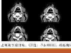 颌下腺腺样囊腺癌1例CT影像