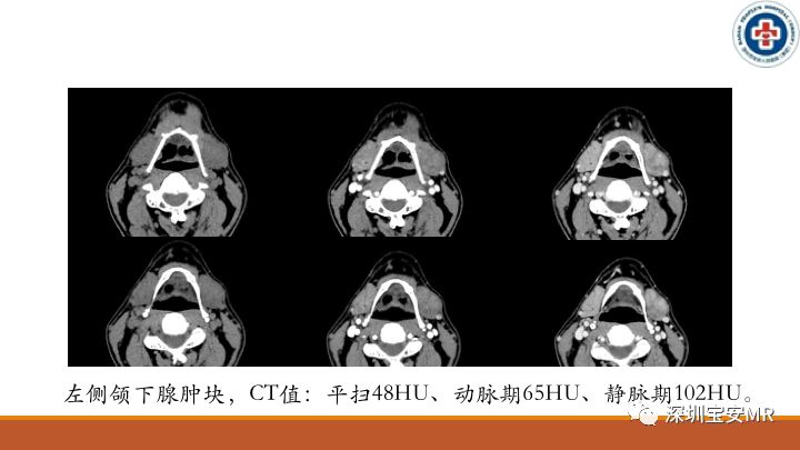 【病例】颌下腺腺样囊腺癌1例CT影像