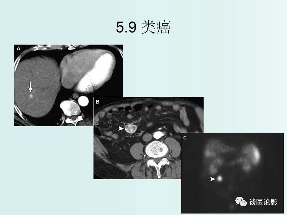 【PPT】腹膜及肠系膜的病变