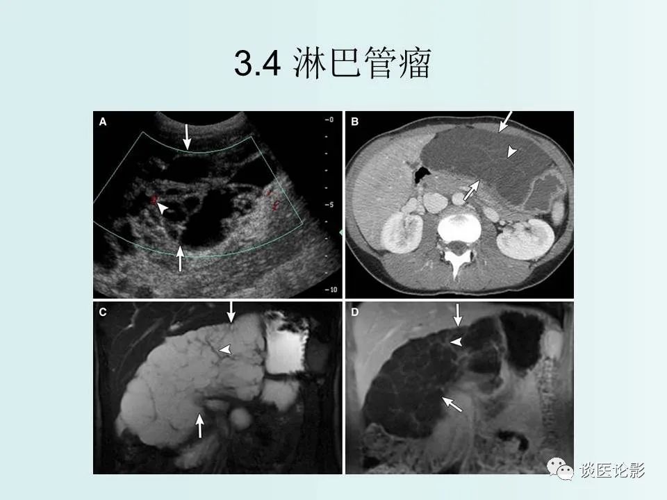 【PPT】腹膜及肠系膜的病变