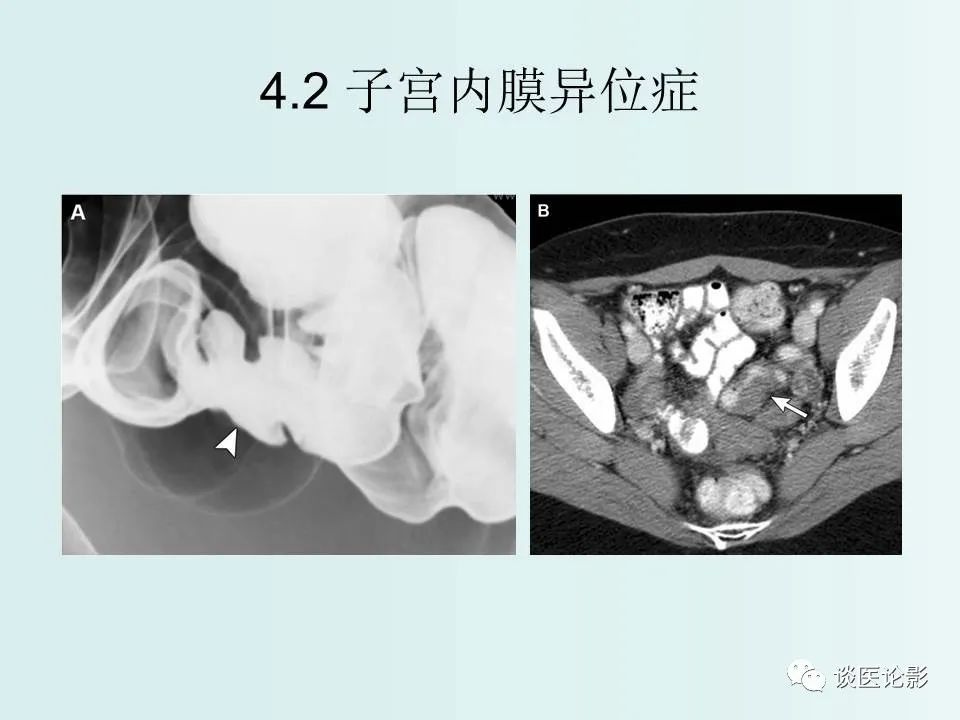 【PPT】腹膜及肠系膜的病变