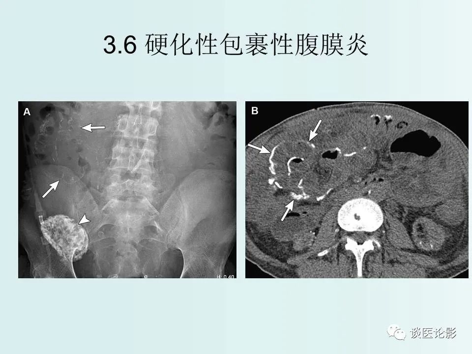 【PPT】腹膜及肠系膜的病变