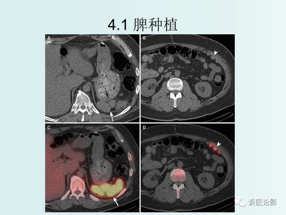 【PPT】腹膜及肠系膜的病变