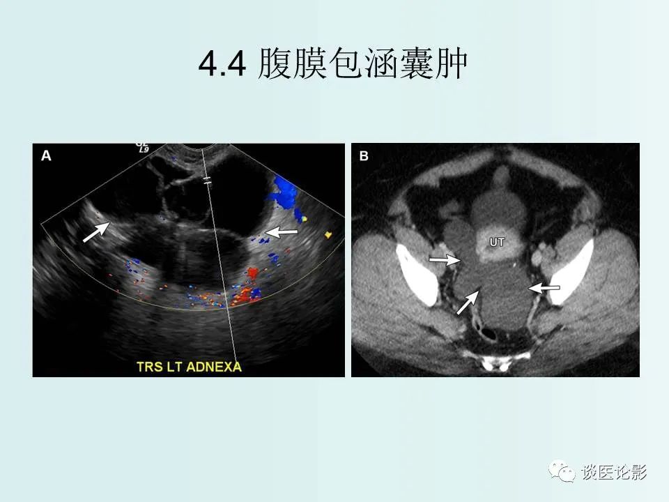 【PPT】腹膜及肠系膜的病变
