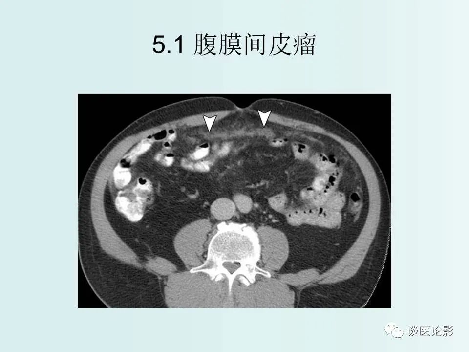 【PPT】腹膜及肠系膜的病变