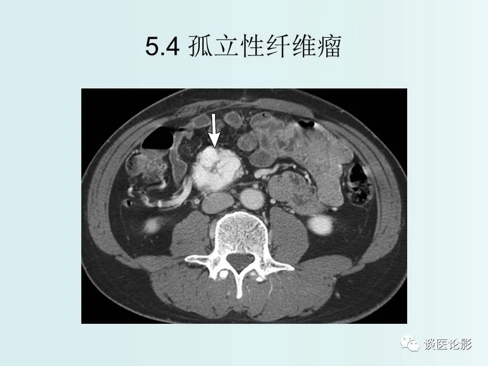 【PPT】腹膜及肠系膜的病变