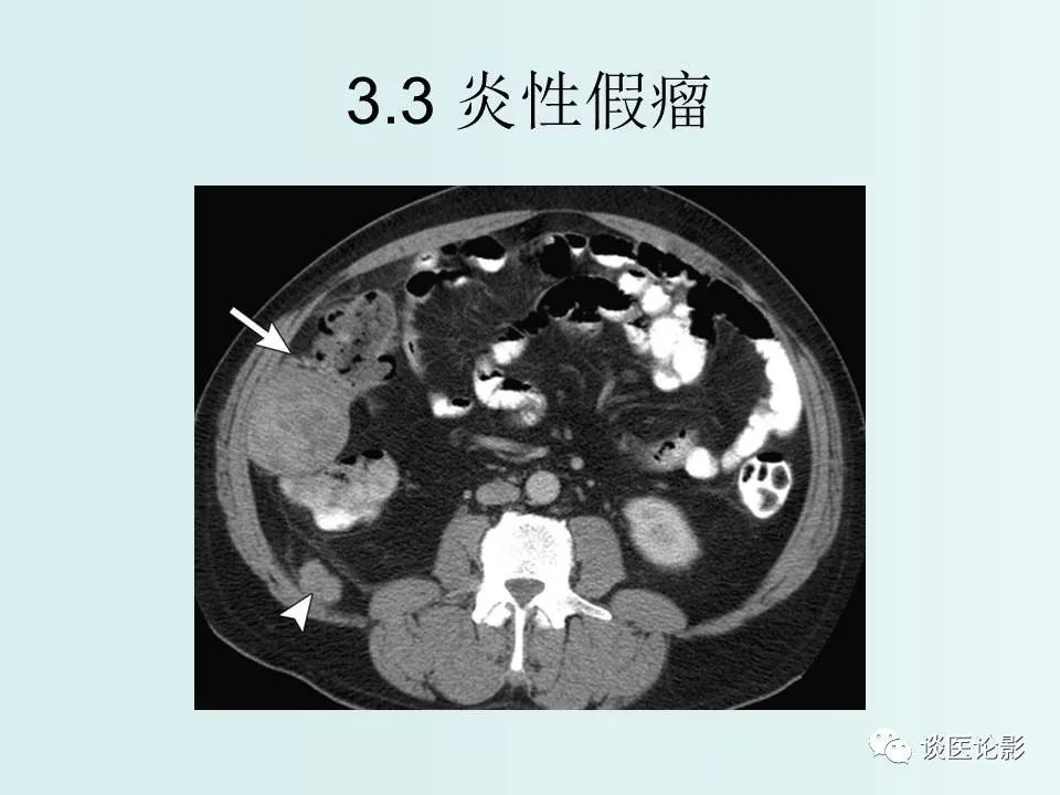 【PPT】腹膜及肠系膜的病变