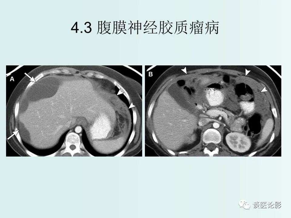 【PPT】腹膜及肠系膜的病变