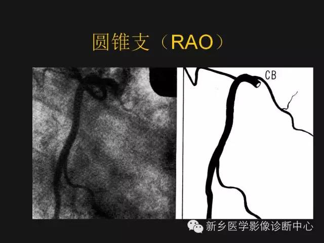 【PPT】冠状动脉造影正常解剖