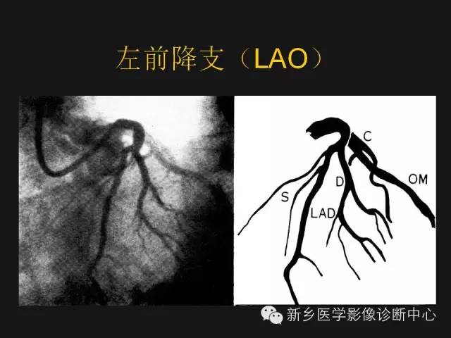 【PPT】冠状动脉造影正常解剖