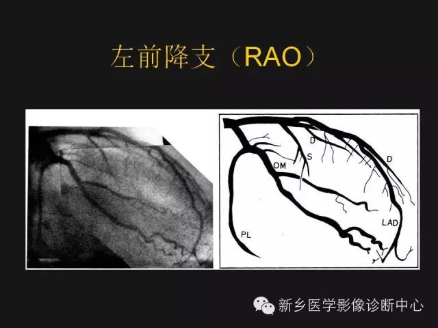 【PPT】冠状动脉造影正常解剖
