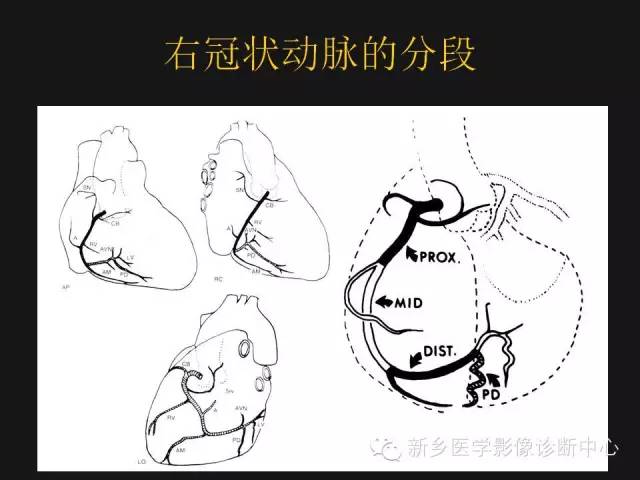 【PPT】冠状动脉造影正常解剖