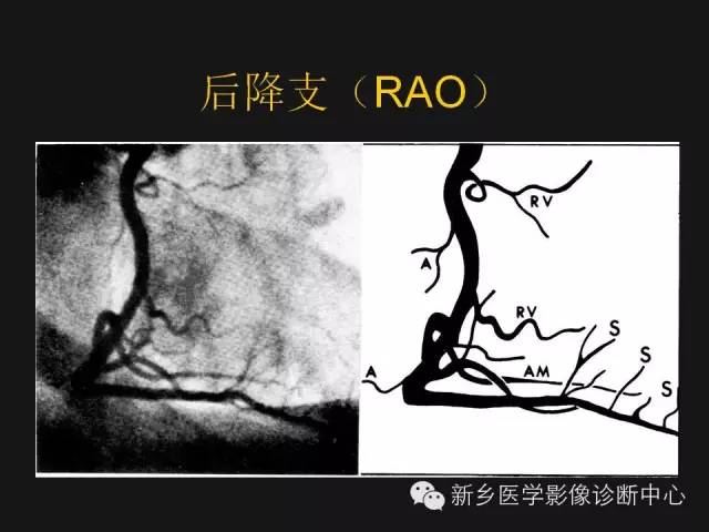 【PPT】冠状动脉造影正常解剖