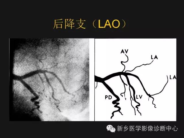 【PPT】冠状动脉造影正常解剖