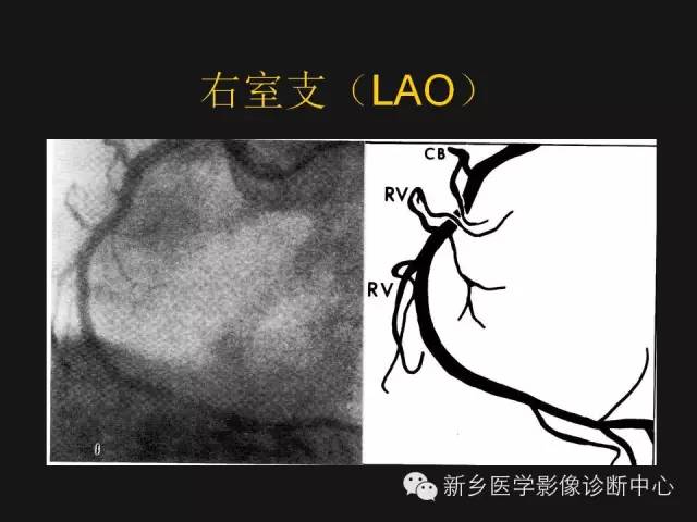 【PPT】冠状动脉造影正常解剖