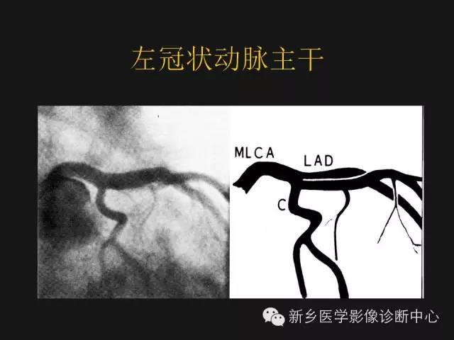 【PPT】冠状动脉造影正常解剖