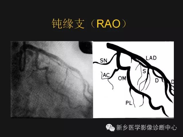 【PPT】冠状动脉造影正常解剖