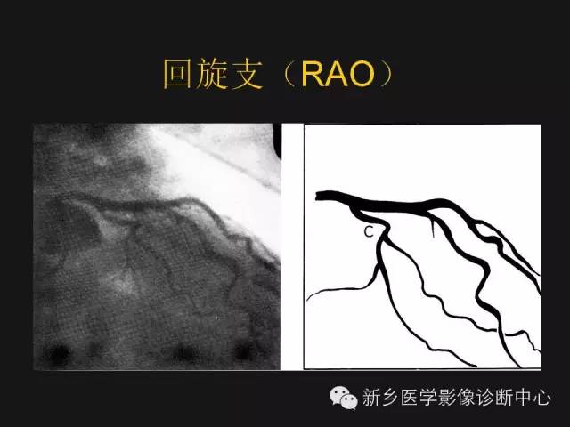 【PPT】冠状动脉造影正常解剖