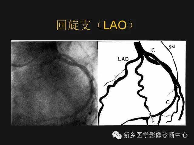 【PPT】冠状动脉造影正常解剖