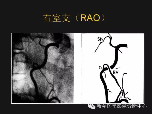 【PPT】冠状动脉造影正常解剖