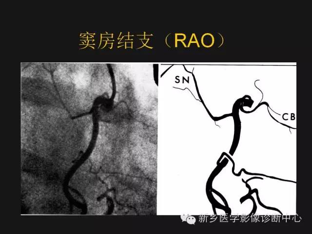 【PPT】冠状动脉造影正常解剖