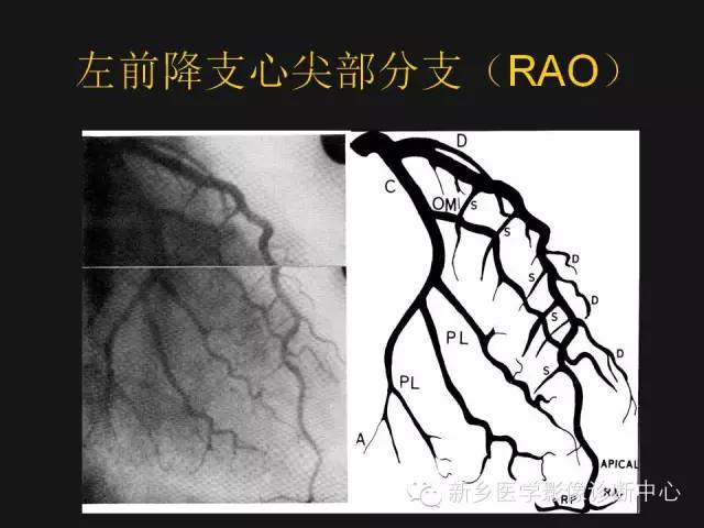 【PPT】冠状动脉造影正常解剖