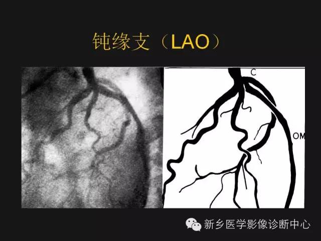 【PPT】冠状动脉造影正常解剖