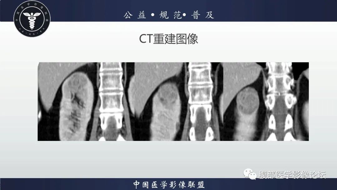 【病例】肾脏乳头状肾细胞癌1例CT及MR影像讨论