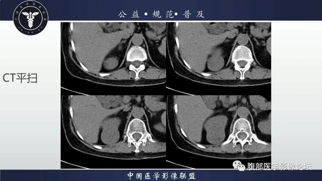 【病例】肾脏乳头状肾细胞癌1例CT及MR影像讨论