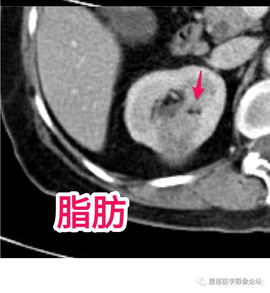 【病例】肾脏乳头状肾细胞癌1例CT及MR影像讨论 【病例】肾脏乳头状肾细胞癌1例CT及MR影像讨论