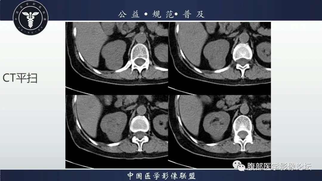 【病例】肾脏乳头状肾细胞癌1例CT及MR影像讨论