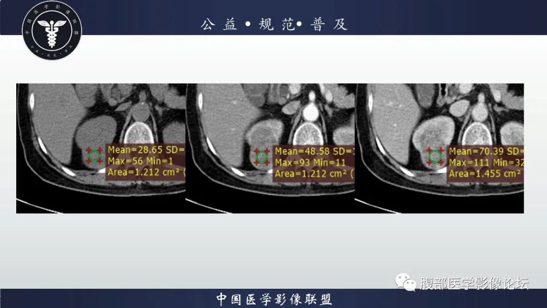 【病例】肾脏乳头状肾细胞癌1例CT及MR影像讨论