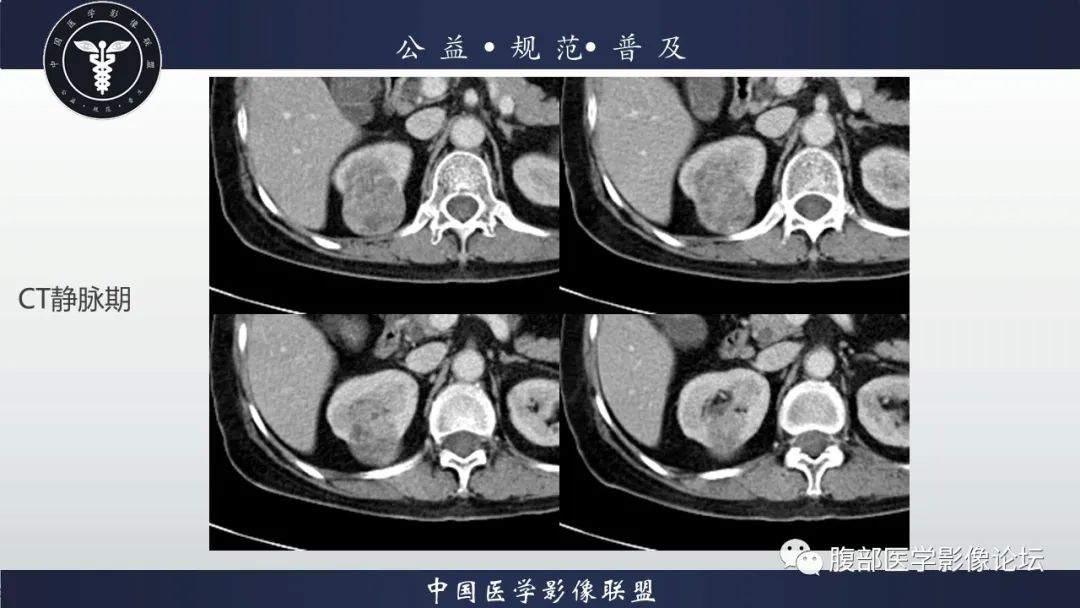 【病例】肾脏乳头状肾细胞癌1例CT及MR影像讨论