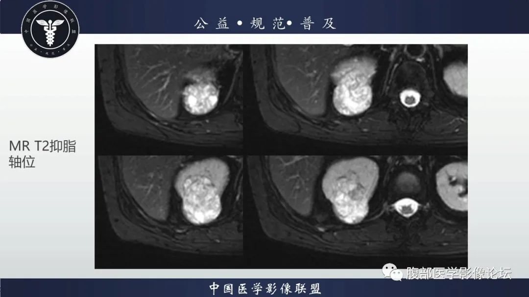 【病例】肾脏乳头状肾细胞癌1例CT及MR影像讨论