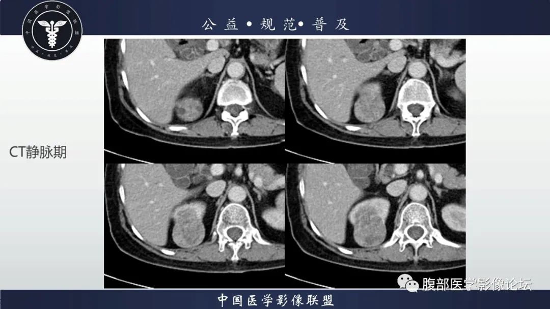 【病例】肾脏乳头状肾细胞癌1例CT及MR影像讨论