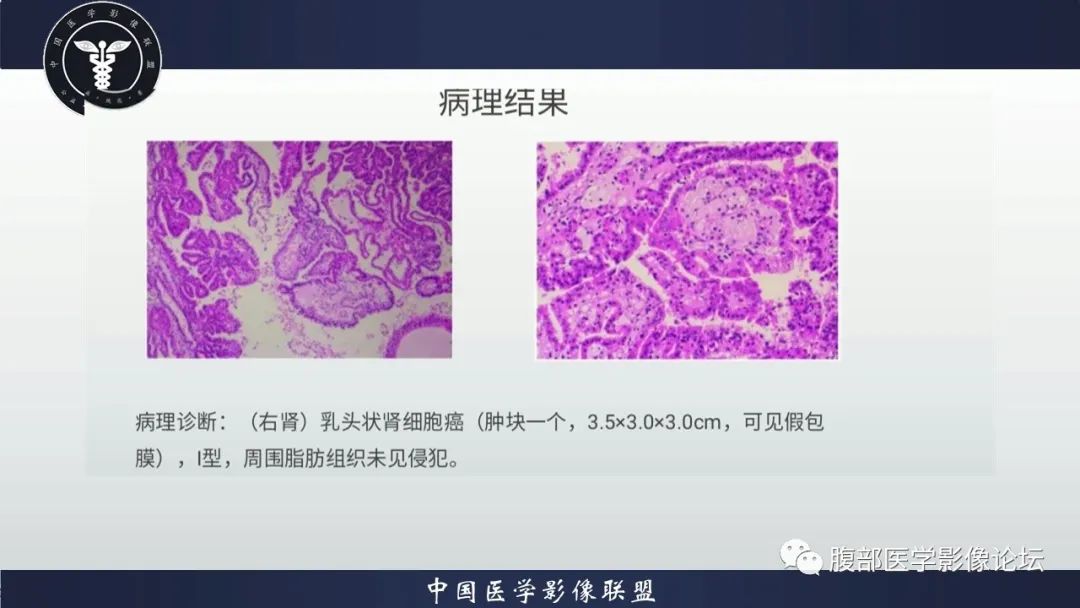 【病例】肾脏乳头状肾细胞癌1例CT及MR影像讨论