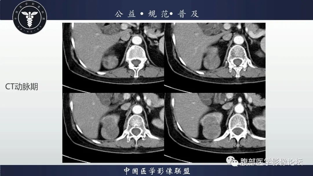 【病例】肾脏乳头状肾细胞癌1例CT及MR影像讨论